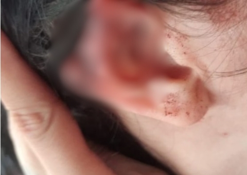 Homem é preso por morder e arrancar pedaço da orelha da namorada 