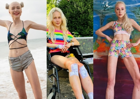 Modelo mostra resultado de alongamento ósseo para ficar 14 cm mais alta