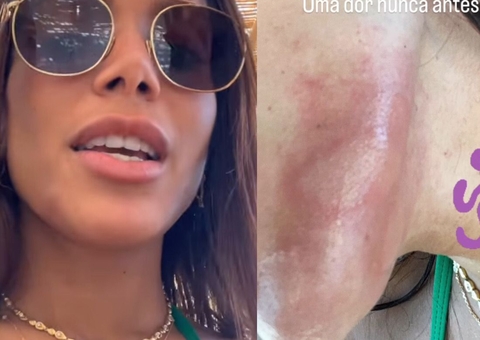 Anitta sofre queimadura de água-viva em Ibiza: 'dor que nunca senti na vida'