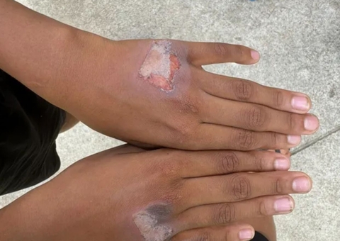 Mulher queima as mãos do filho de 10 anos com chapinha por causa de iogurte