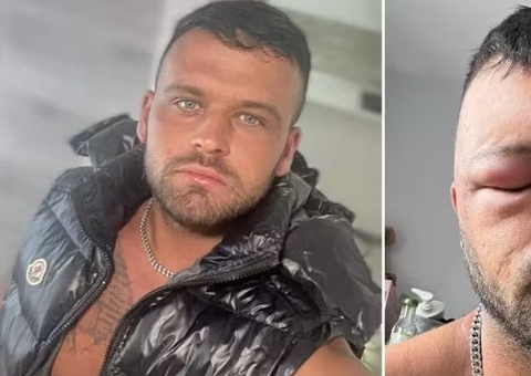 Homem fica com a 'cabeça gigante' após reação alérgica a tinta de cabelo