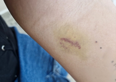 Manchas roxas pelo corpo? Elas podem ser sinais de problemas vasculares