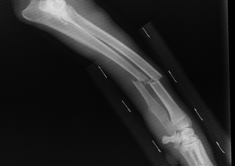 Entenda o que é politraumatismo; causa da morte de vítimas do avião que caiu em Vinhedo
