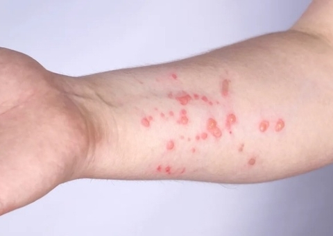 Brasil supera marca de mil casos de mpox em 2024