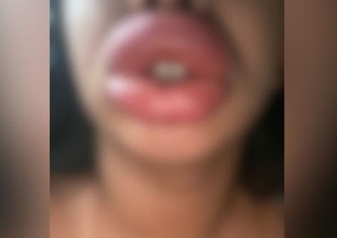 Polícia investiga mulher que prometia 'boca de Angelina Jolie' e deixou clientes deformadas