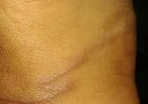 Larvas vivas são encontradas no pé de criança após brincadeira