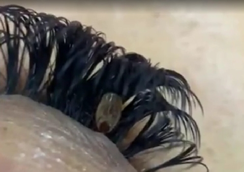 Designer encontra carrapato preso em cílios de cliente 