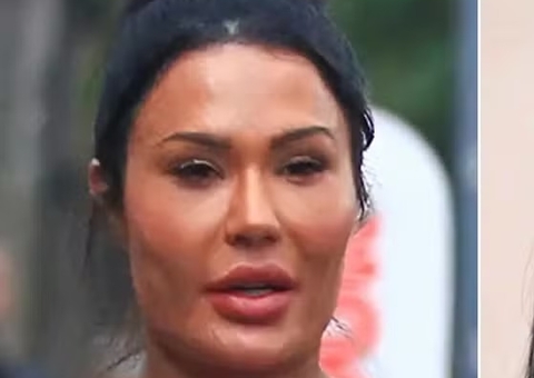 Gracyanne Barbosa remove harmonização do rosto e mostra resultado; veja