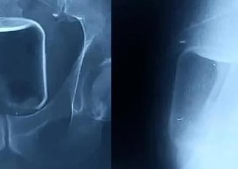 Homem passa por cirurgia para retirar copo de vidro do ânus 