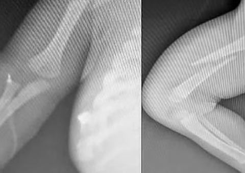 Bebê é internado com fraturas após ser espancado pelo pai por 'chorar demais'