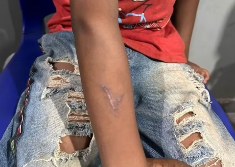 Pecuarista queima braço de criança indígena com ferro de marcar gado