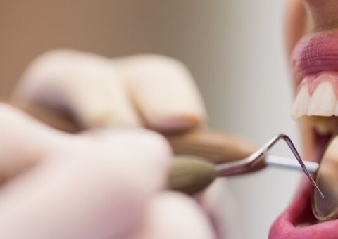 Adolescente sofre necrose nos dentes após fazer aplicação de lentes de resina