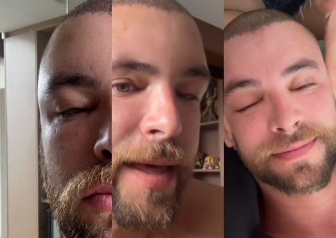 Ex-BBB Gustavo Beats aparece irreconhecível após transplante capilar 