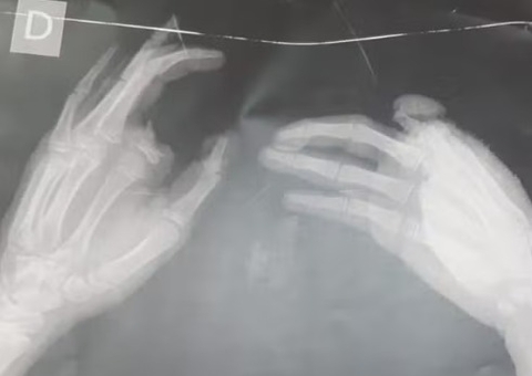 Criança perde dedo após explosão de bomba que encontrou na sede do Sport