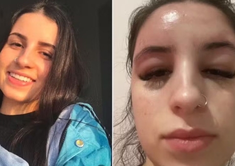 Jovem viraliza no TikTok após infecção grave causada por espremer espinhas