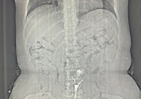 Mulher é presa com cápsulas de cocaína no estômago em aeroporto de Belém