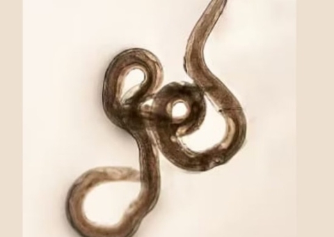 Mulher descobre vermes no cérebro após queimação nos pés