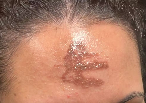 Fiéis sofrem queimaduras com cinzas da Quaresma em missa