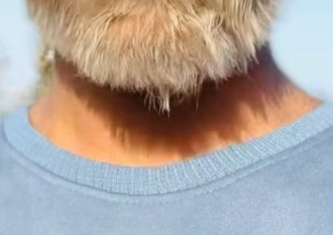 Adolescente da Índia quebra recorde no Guinness por ter o rosto mais peludo