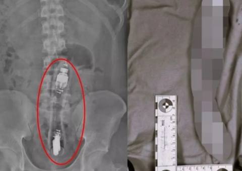 Vibrador ligado é encontrado dentro de ânus de paciente durante cirurgia  
