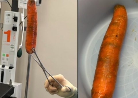 Homem é hospitalizado com cenoura de 20 cm presa no ânus