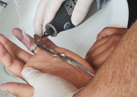 Mais de 400 pessoas são socorridas por ano em Manaus com anéis presos aos dedos