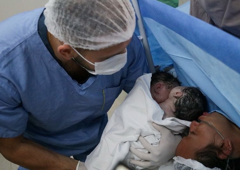 Parto raro: Mãe dá à luz gêmeas siamesas em Manaus