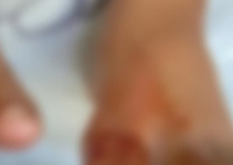 Menino de 9 anos tem dedos arrancados por piranhas em lago de Goiás