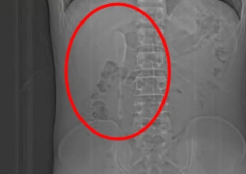 Achou que era um sonho: homem descobre colher no intestino após cinco meses