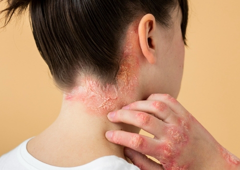 Calor e umidade do Amazonas exigem atenção especial no cuidado com a psoríase