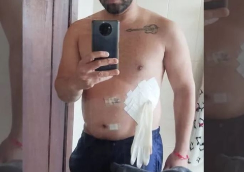 Médico coloca luva cirúrgica no lugar de bolsa de colostomia em paciente e causa revolta