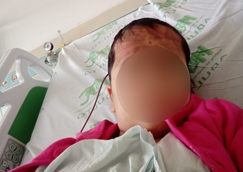 Menina de 9 anos quase fica cega e passa 21 dias internada após escova progressiva