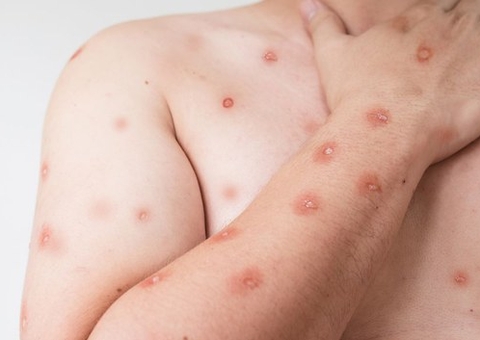 Primeiro caso de Mpox no Brasil em 2026 é confirmado em Porto Alegre