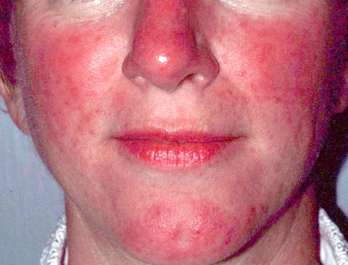 rosacea.jpg