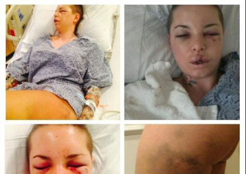 Atriz pornô fala sobre momentos de terror e mostra lesões 