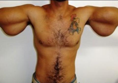 Jovem quase tem braços amputados após injetar óleo nos bíceps