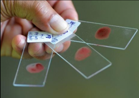 Exame de sangue pode ajudar a detectar câncer de pulmão