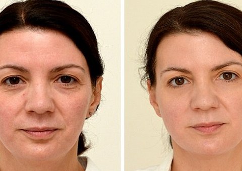 Mulher fica com a pele mais limpa tomando 3 litros de água por dia