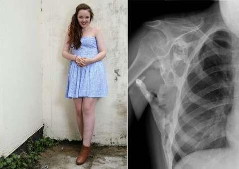 Adolescente com doença rara, tem em seu corpo outro esqueleto nascendo 