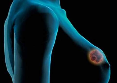 Médico condenado por implantar medidor em lugar de silicone