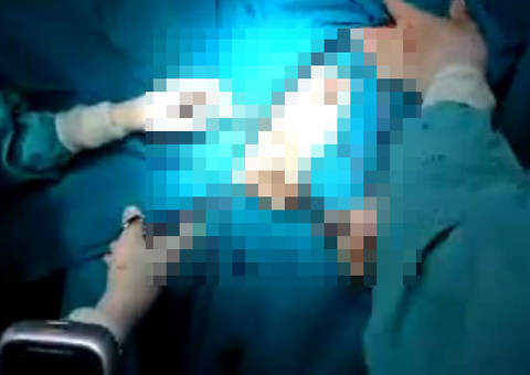 Homem fica com cinta peniana presa no ânus e vai parar no hospital