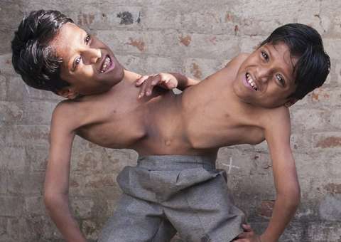 Irmãos siameses não querem se separar e família apoia