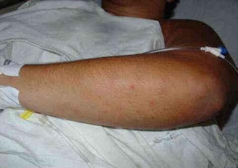 Semsa descarta possibilidade de surto de meningite em Manaus. Mas tire dúvidas