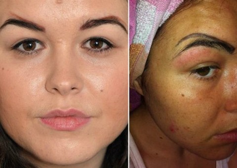 Mulher desejava ficar com olhar mais atraente e acabou com quatro sobrancelhas após erro estético