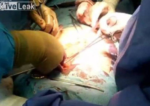 Compulsão: Médicos retiram do estômago de uma mulher 78 talheres 