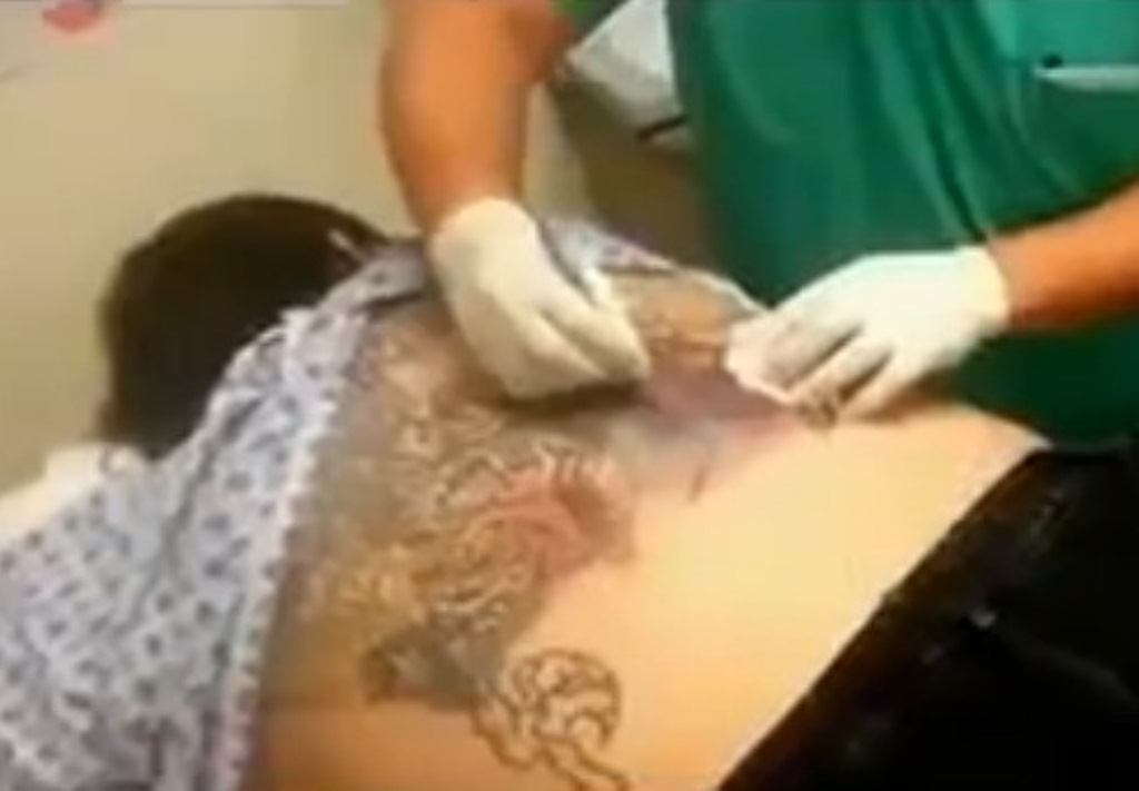 Bizarro: o que acontece quando uma tatuagem infecciona e dá errado