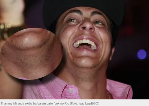  Thammy Miranda começa a ter barba após retirar seios