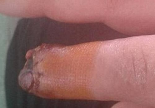 Após usar unhas postiças, jovem tem parte do dedo amputado 