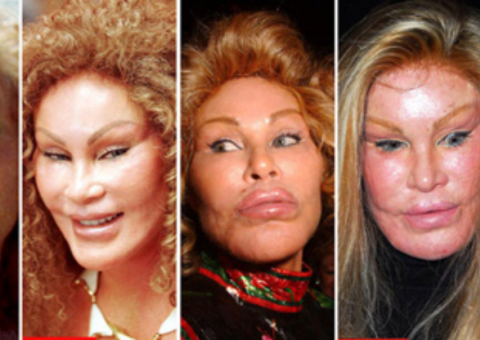 Famoso que exageraram na "plástica"