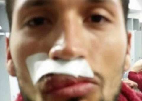 Zagueiro posta foto do rosto desfigurado após partida de jogo